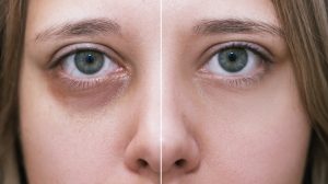 Under Eye Filler – What Is It?